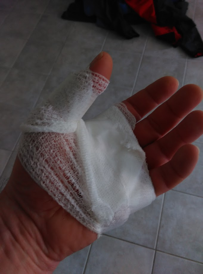 Skadad hand på grund av husvagnstvätt